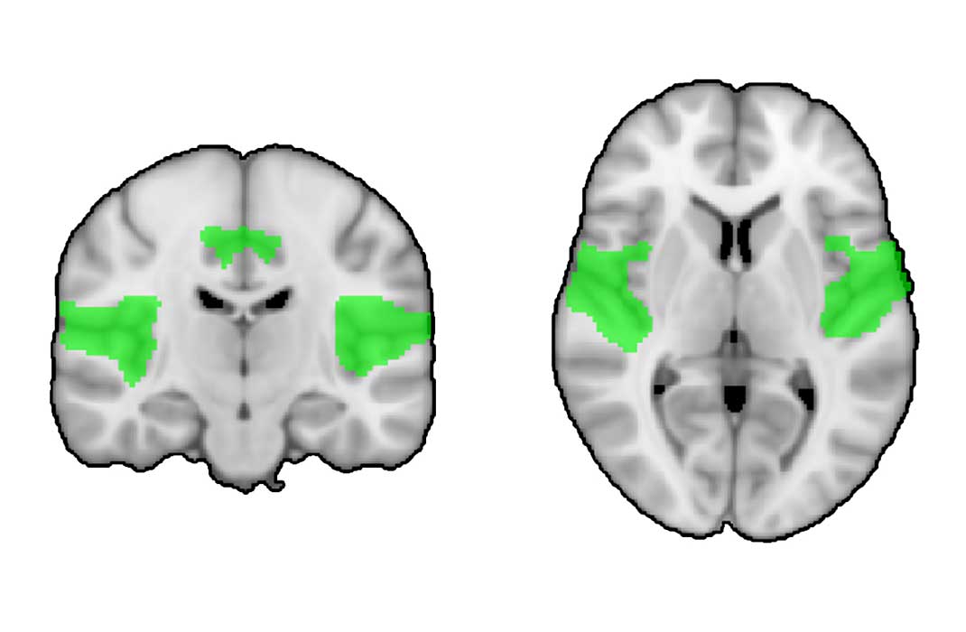 Top and frontal brain scans with the areas affected by schizophrenia highlighted in green.